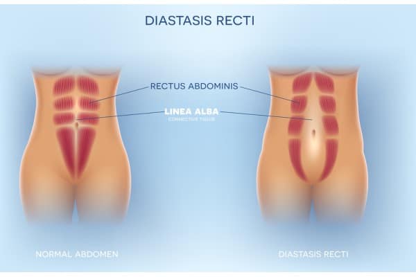What Non-Surgical Options Are Available for Diastasis Recti Stow on the Wold?