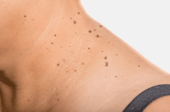 Are you looking for easy skin tag removal Stow on the Wold - then contact Spire today!