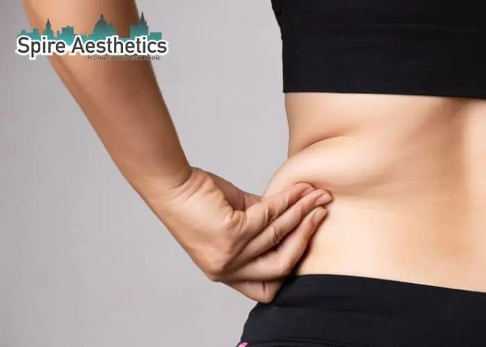 Image of woman pinching fat on their hips Stow on the Wold. Fat Freezing treatment