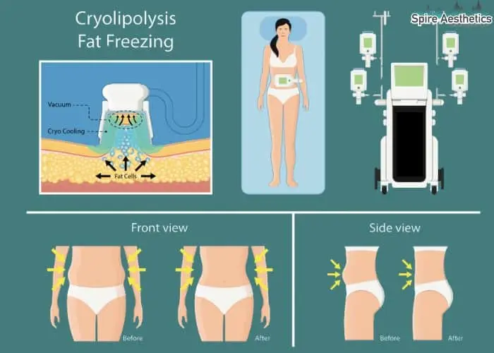 Fat freezing treatment Stow on the Wold benefits for competitions to remove stubborn fat deposits.