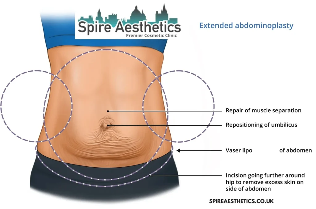 Understanding Loose Skin After Gastric Band Stow on the Wold Surgery and HIFU Treatment