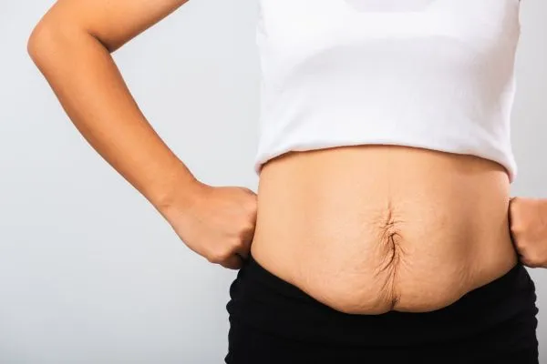 Image of a woman's stomach after weight loss with sagging skin following a gastric band Stow on the Wold