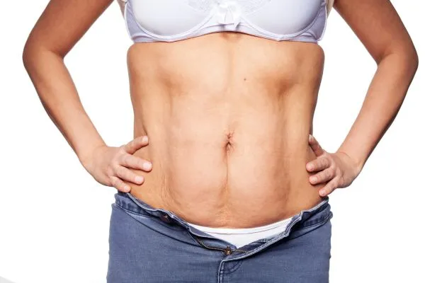 sagging skin on woman's stomach after weight loss injections Stow on the Wold