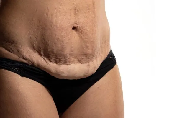 Image of womans stomach after weight loss injections Stow on the Wold showing saggy skin
